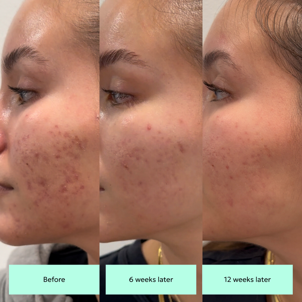 HyperFix Fading Toner results for fading hyperpigmentation