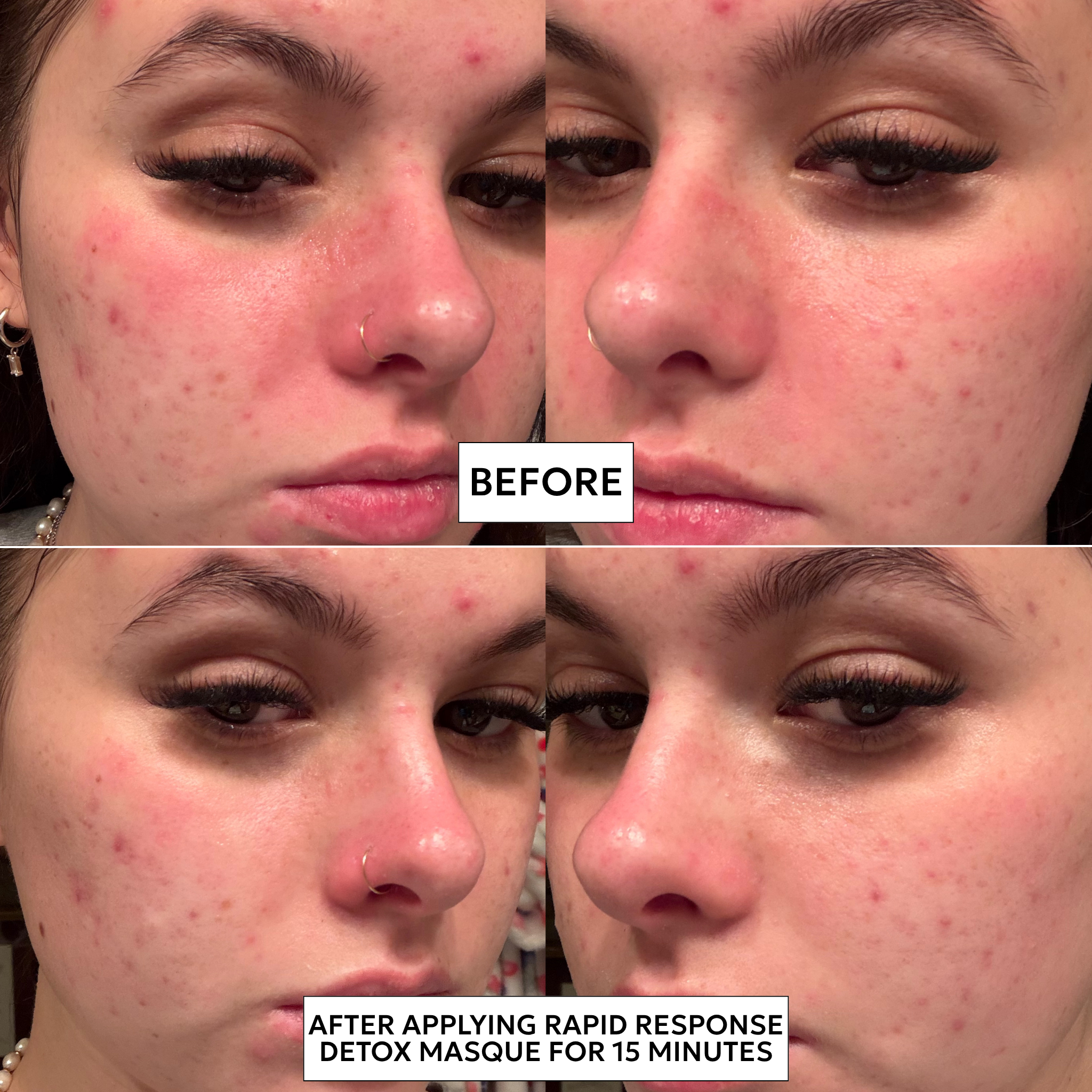 Face Mask for Acne: Rapid Response Detox Masque - Renée Rouleau Face Mask for Acne: Rapid Response Detox Masque - Renée Rouleau