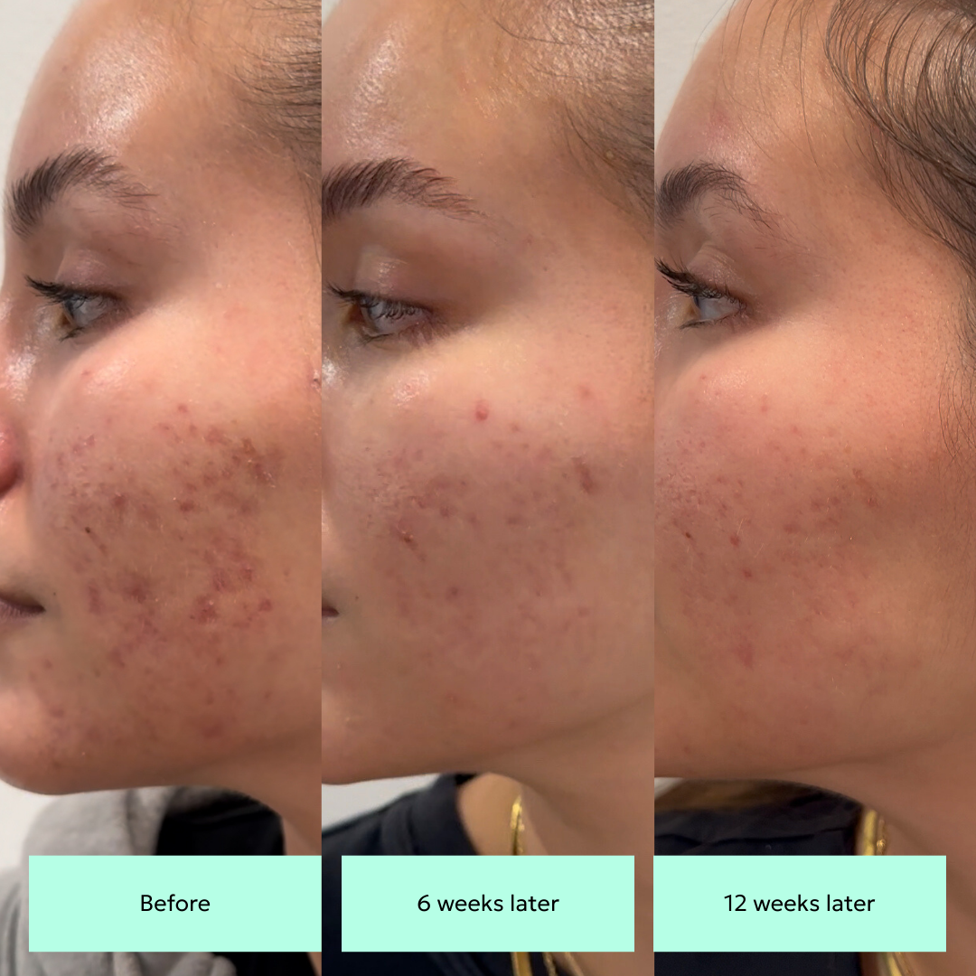HyperFix Fading Toner results for fading hyperpigmentation