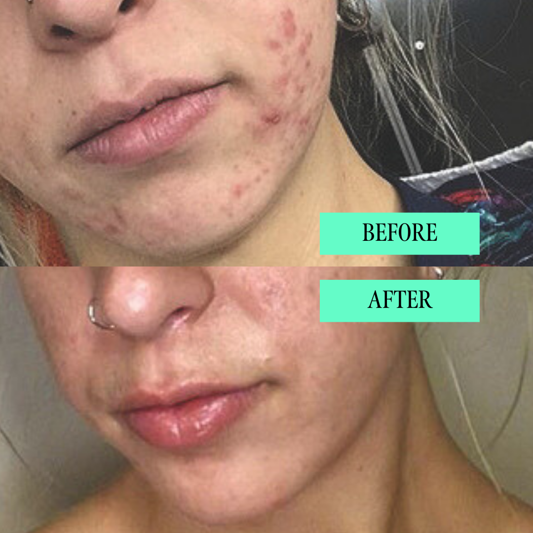 Chin Breakout Treatment Kit (Rapid Response Detox Masque + Anti Bump Solution)