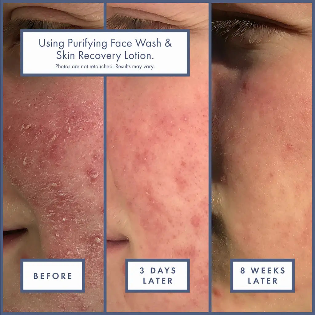 Purifying Face Wash and Skin Recovery Lotion before after results