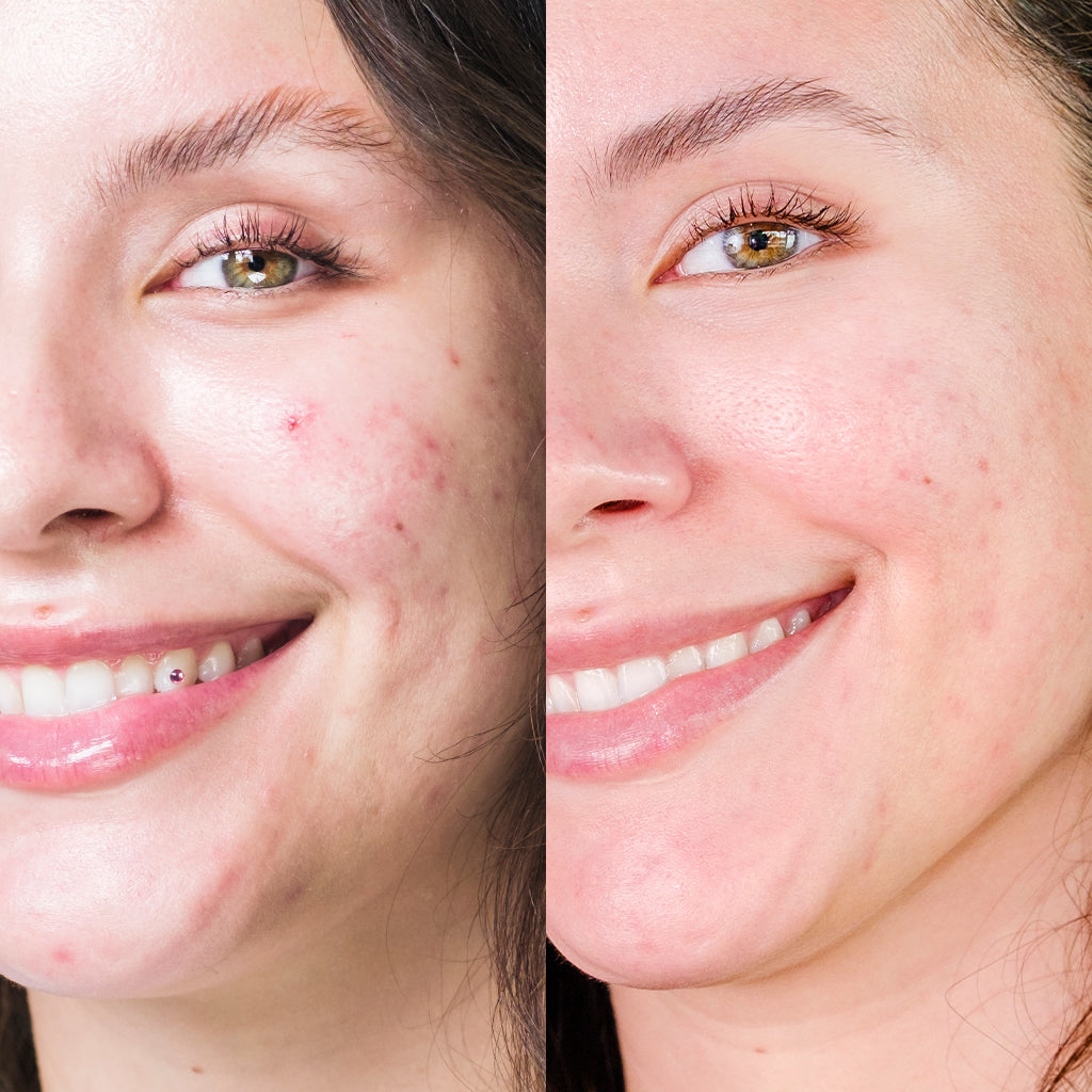 Renée Rouleau HyperFix Fading Toner Before After