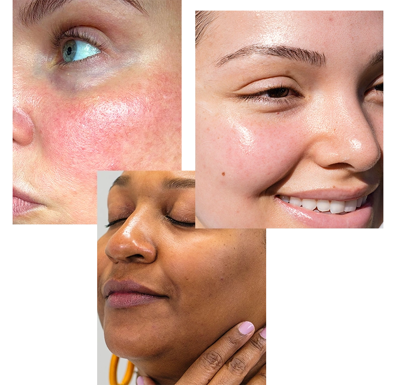 SKIN-TYPE-5.webp__PID:d9f15d72-86bc-4274-b0c1-4f80e4199bae