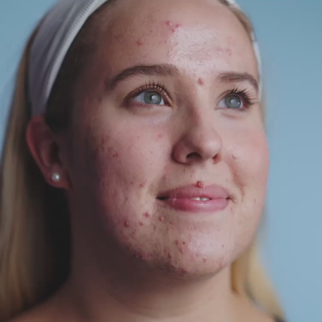 Dual Enzyme Softening Peel Video